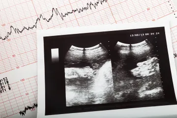 Cardiogram ultrasound baby pregnant Credit Aykut Erdogdu Shutterstock CNA