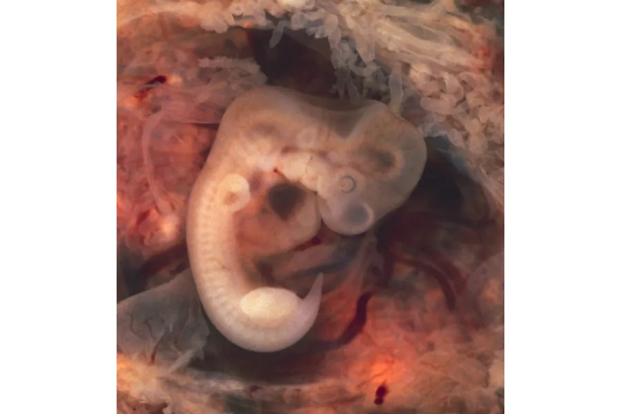 A human embryo in the seventh week of ectopic pregnancy in a Fallopian tube. ?w=200&h=150