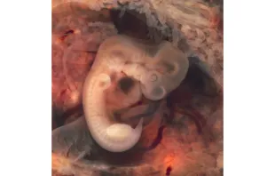 A human embryo in the seventh week of ectopic pregnancy in a Fallopian tube.   Ed Uthman via Flickr (CC BY 2.0).