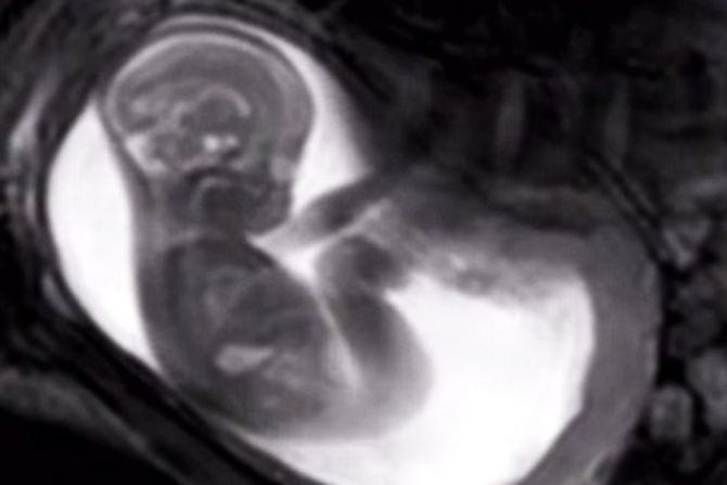 MRI scan screenshot Credit iFIND via ChannelMumscom CNA 1
