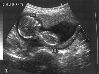 Ultrasounds can be used by parents wishing to procure a sex-selective abortion. ?w=200&h=150