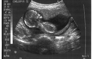 Ultrasound.   CDC/Jim Gathany, public domain.