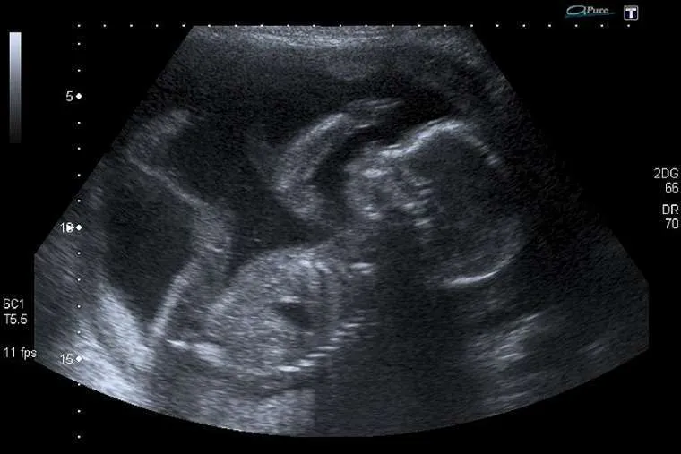 An unborn baby at 20 weeks. ?w=200&h=150