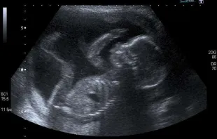 An unborn baby at 20 weeks.   Steve via Flickr (CC BY-NC 2.0).