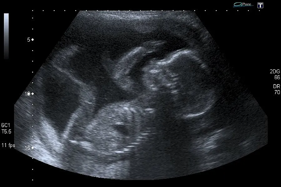 Unborn baby at 20 weeks. ?w=200&h=150