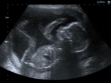 An unborn baby at 20 weeks. 