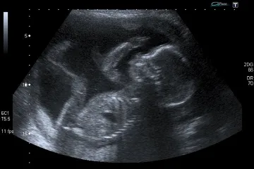 Unborn baby at 20 weeks Credit Steve via Flickr CC BY NC 20 CNA