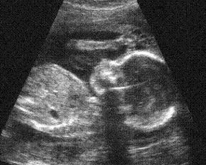 An ultrasound image of an unborn child.?w=200&h=150
