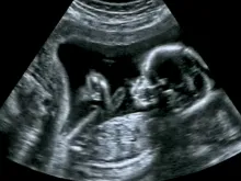 Ultrasound of a baby in the womb. 