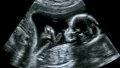 Ultrasound of a baby in the womb.