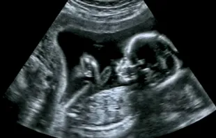 Ultrasound of a baby in the womb. GagliardiPhotography/Shutterstock