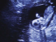 Ultrasound image.
