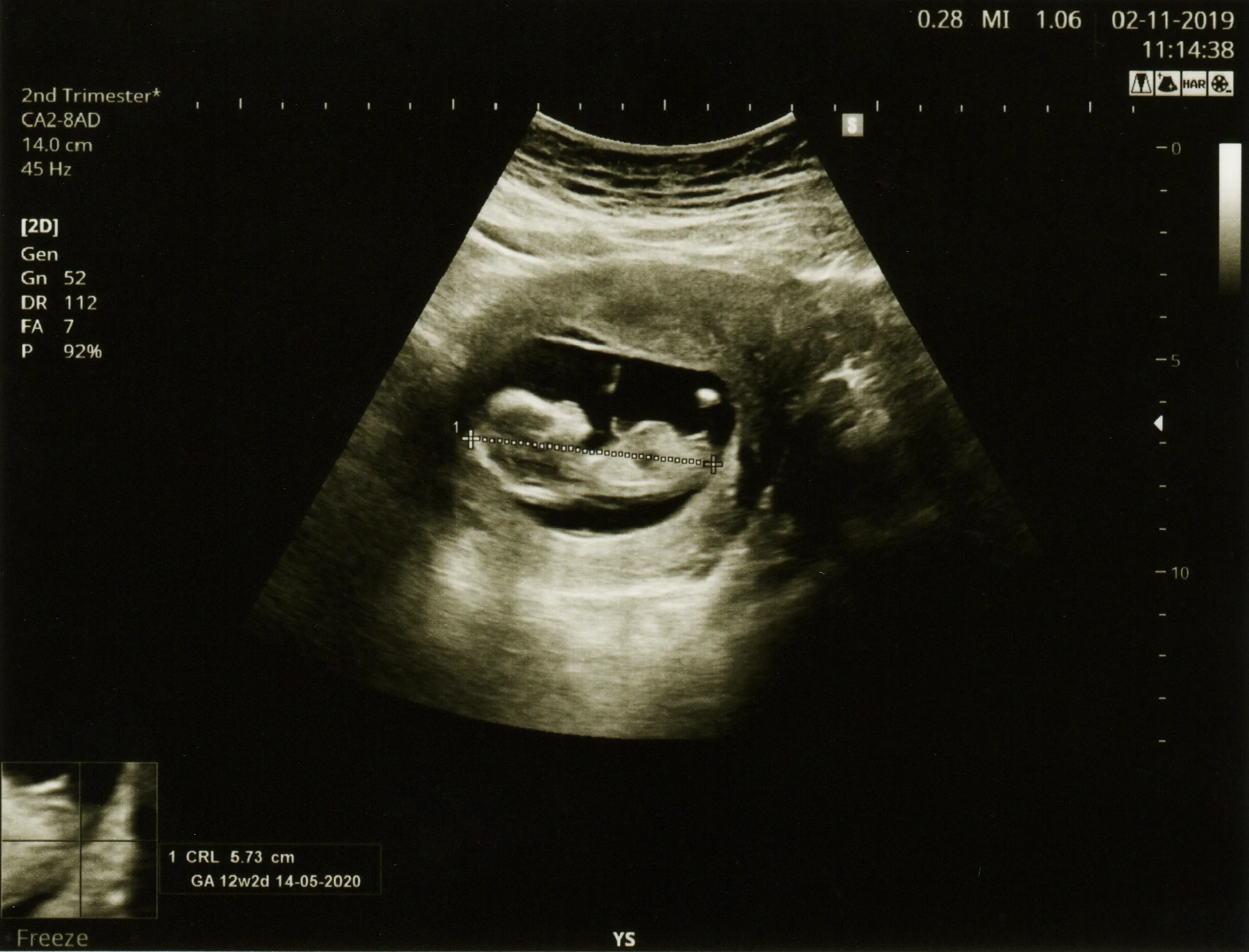 A sonogram picture of a fetus in the second trimester of a woman's pregnancy?w=200&h=150