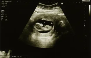 A sonogram picture of a fetus in the second trimester of a woman's pregnancy Shutterstock