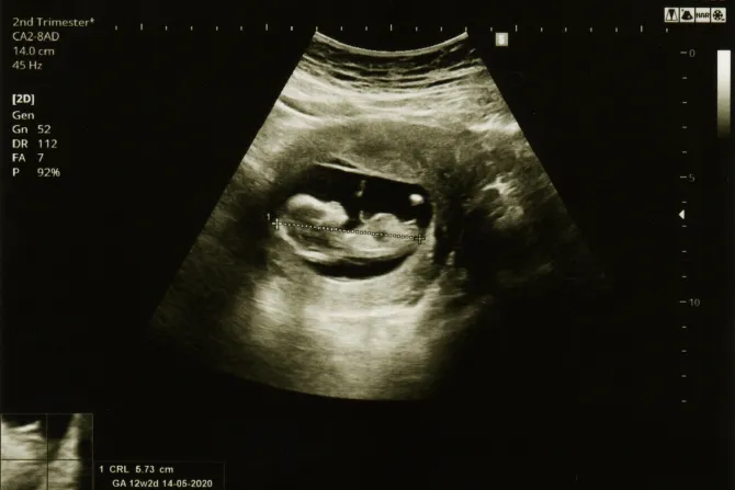 sonogram fetus